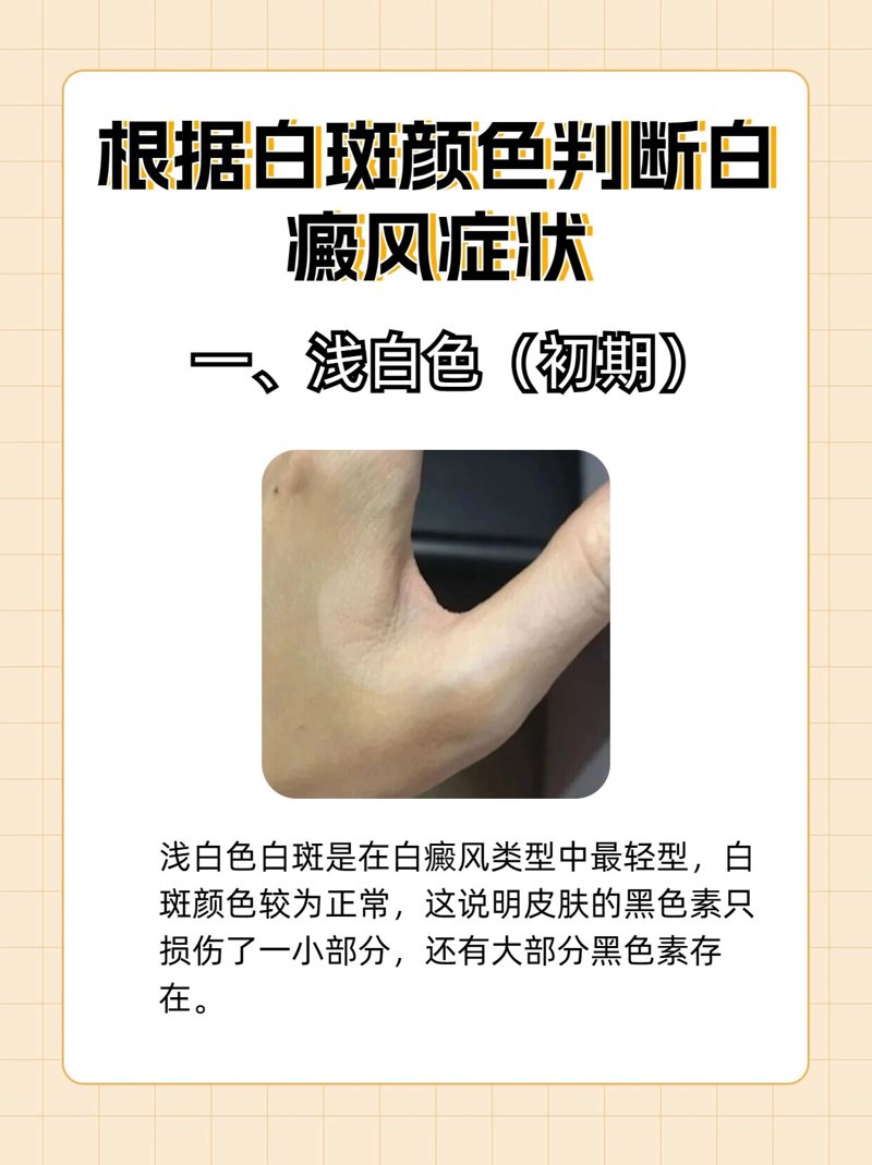 在寻找最好的白癜风治疗方法时，许多人将目光投向了“国丹袪白”。今天我们就来聊聊这种疗法及其可靠性。