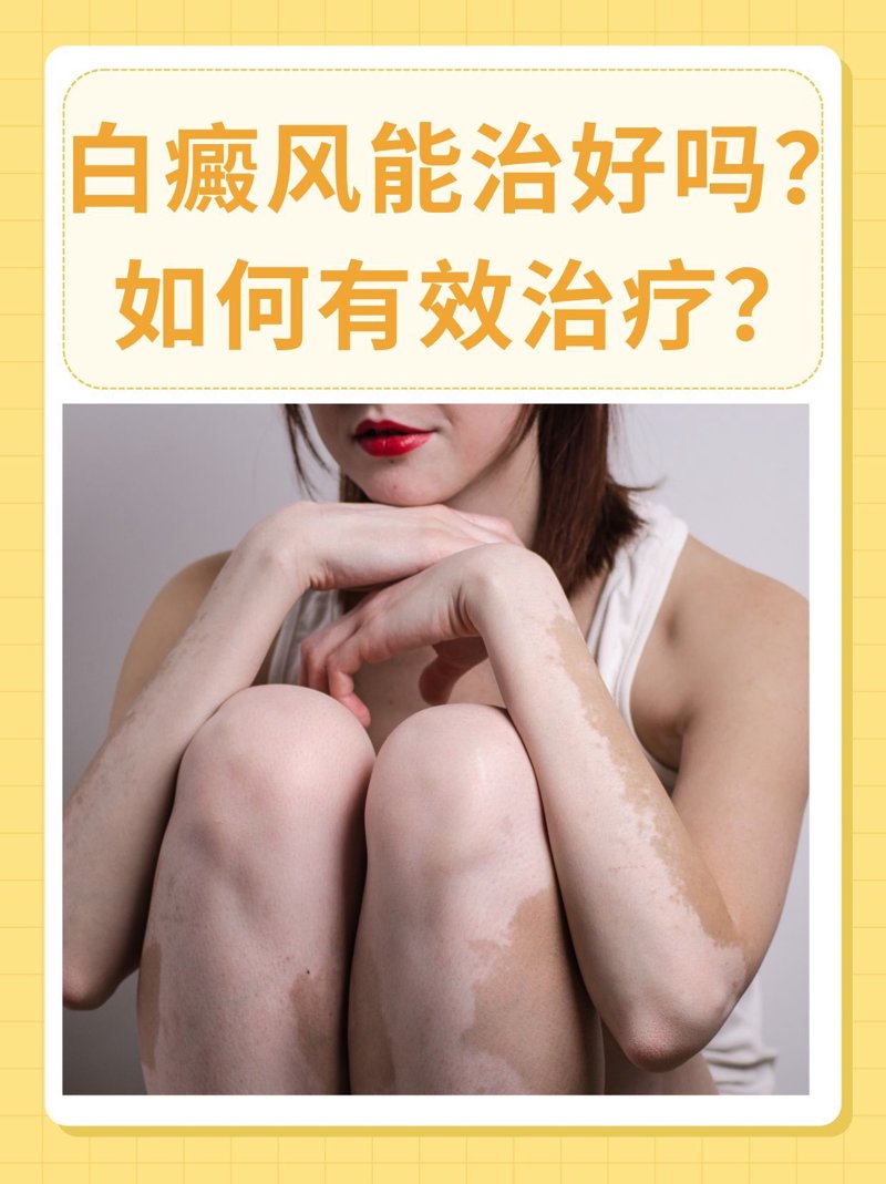 白斑治疗有哪些方法？选择最合适的方案